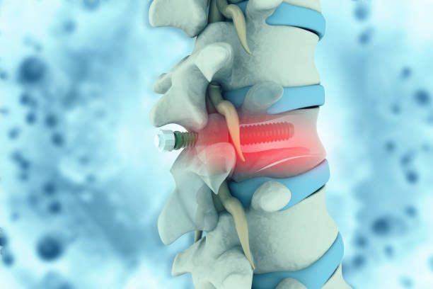 3D illustration showing part of the human spine with an implant and screws for support.